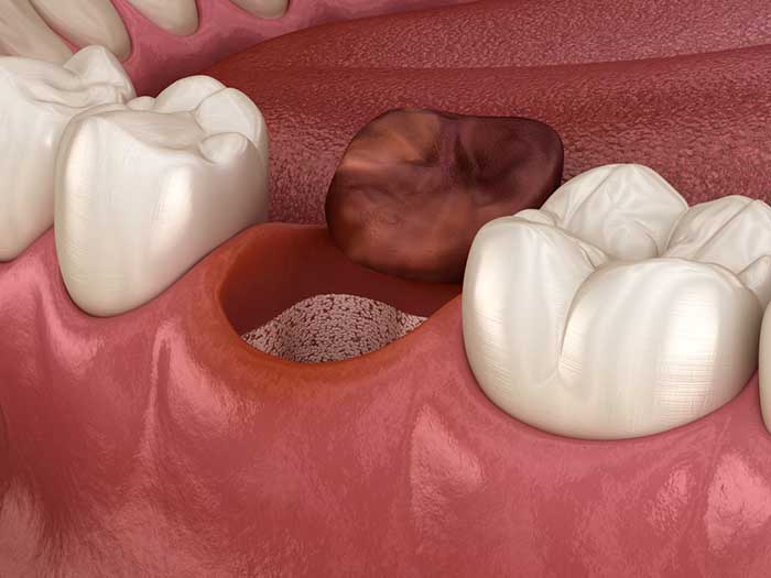 10 причин альвеолита после удаления зуба