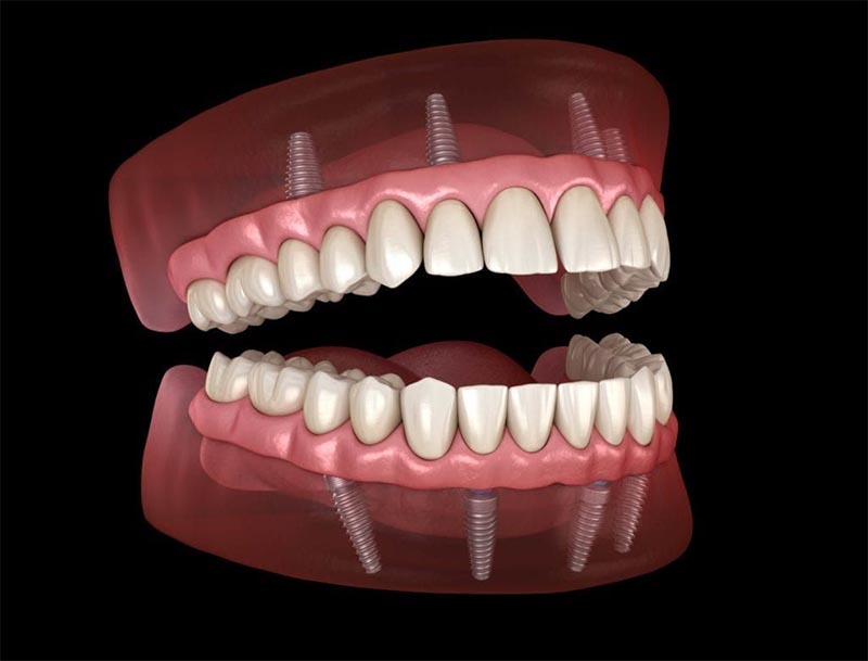 Чем определяются цены на протезирование зубов в стоматологии