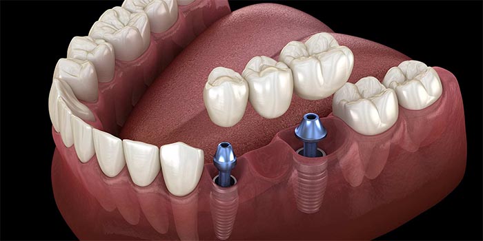 Что такое зубной мост и зубной имплантат?