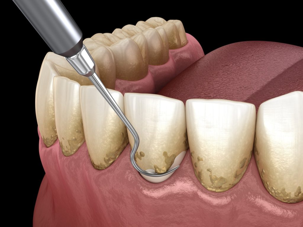 Распространенные болезни зубов и десен