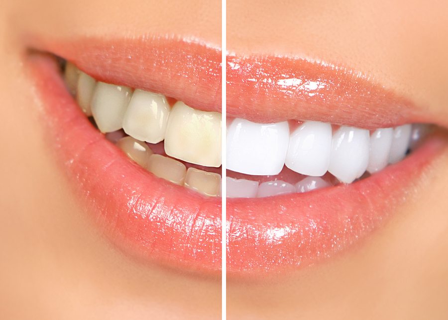 Шесть популярных мифов про отбеливание зубов
