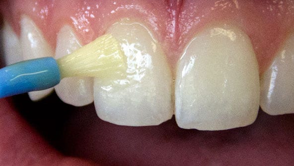 Лечение флюороза зубов