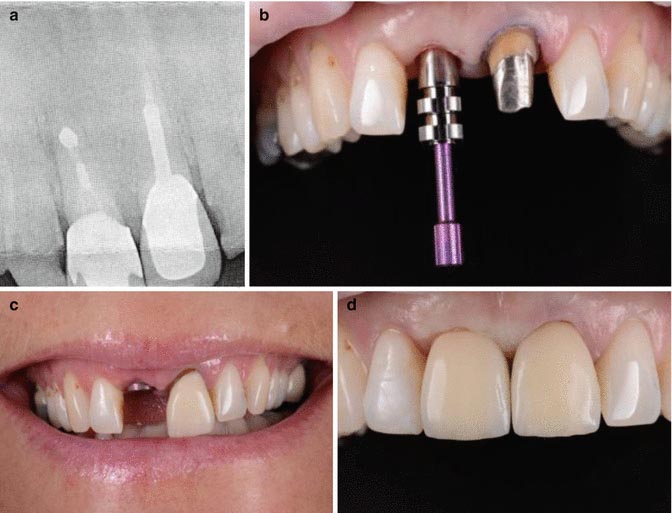 Восстановление прежнего вида зубов
