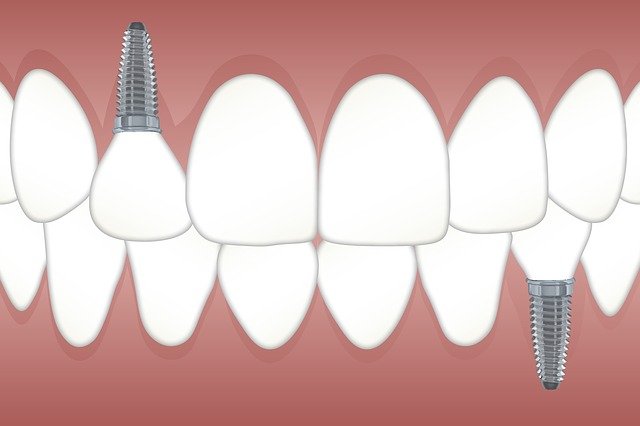 Зубные имплантаты. Противопоказания